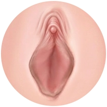 소음순 변형