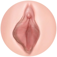 소음순 변형