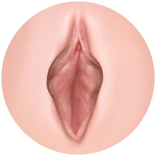 소음순 변형
